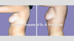 Female Abdomen liposuction
