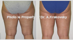 Female Saddlebag liposuction