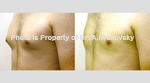 Male Breast (Gynecomastia) liposuction
